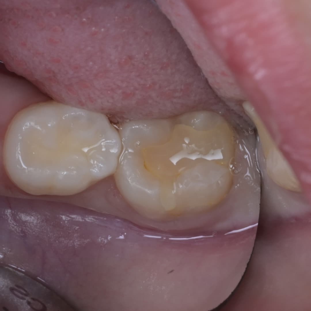 레진빌드업 슬라이드 1/9