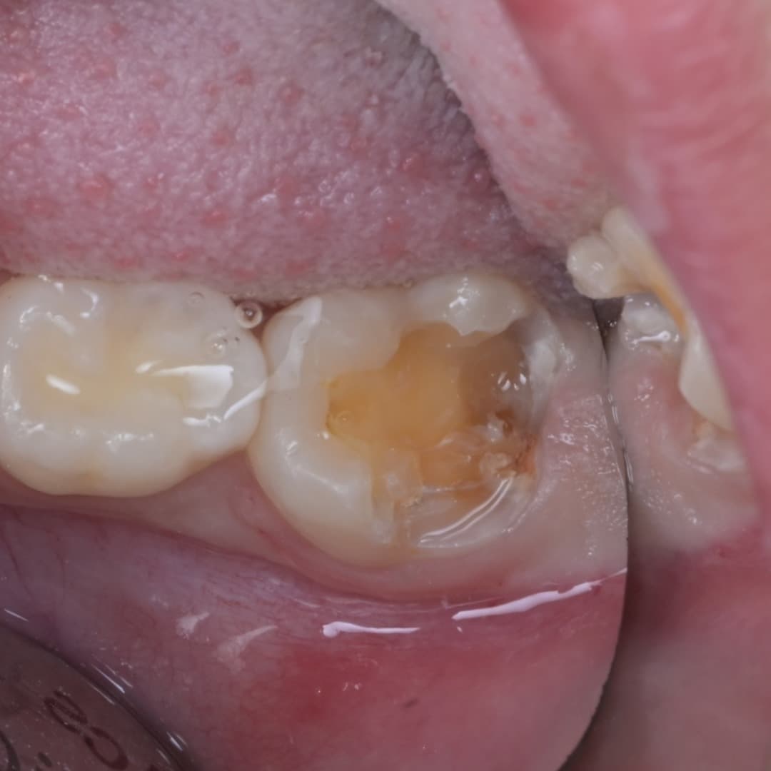 레진빌드업 슬라이드 2/9