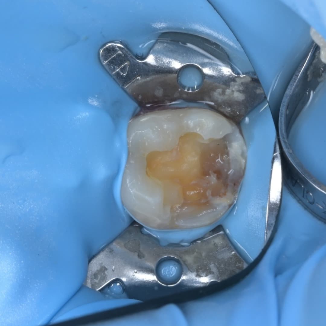 레진빌드업 슬라이드 3/9