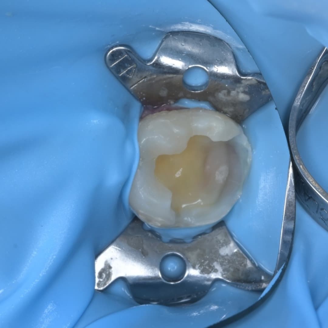 레진빌드업 슬라이드 4/9