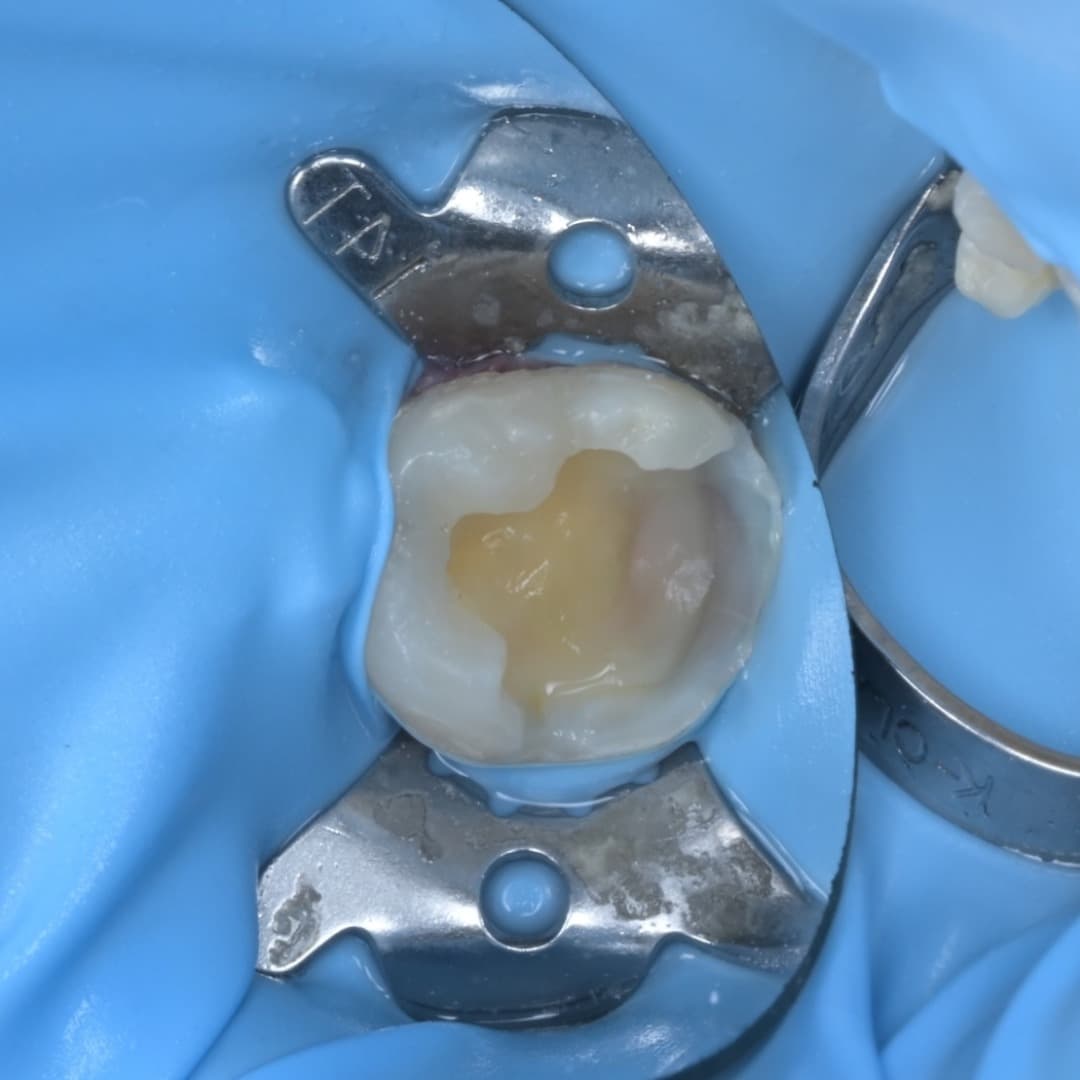 레진빌드업 슬라이드 5/9