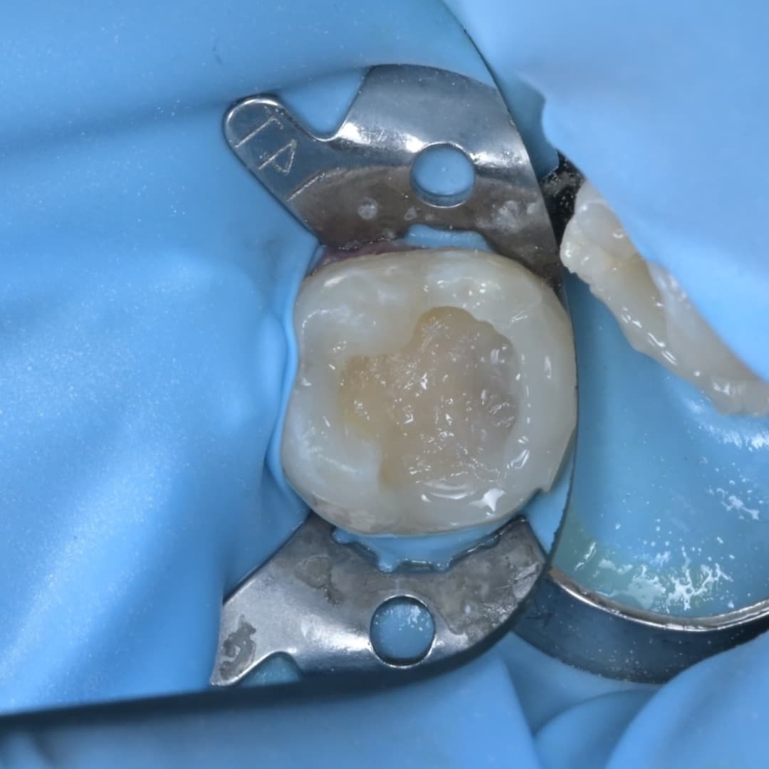 레진빌드업 슬라이드 6/9