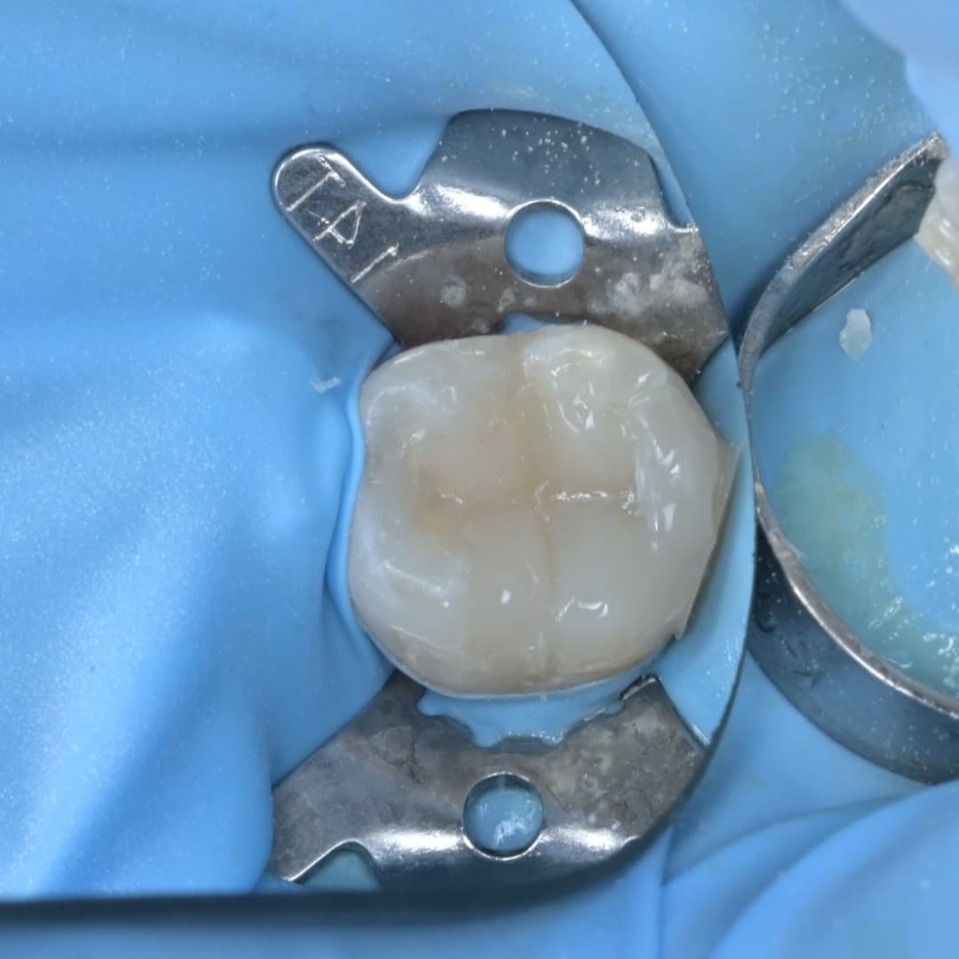 레진빌드업 슬라이드 7/9