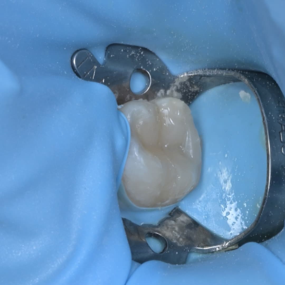 레진빌드업 슬라이드 8/9