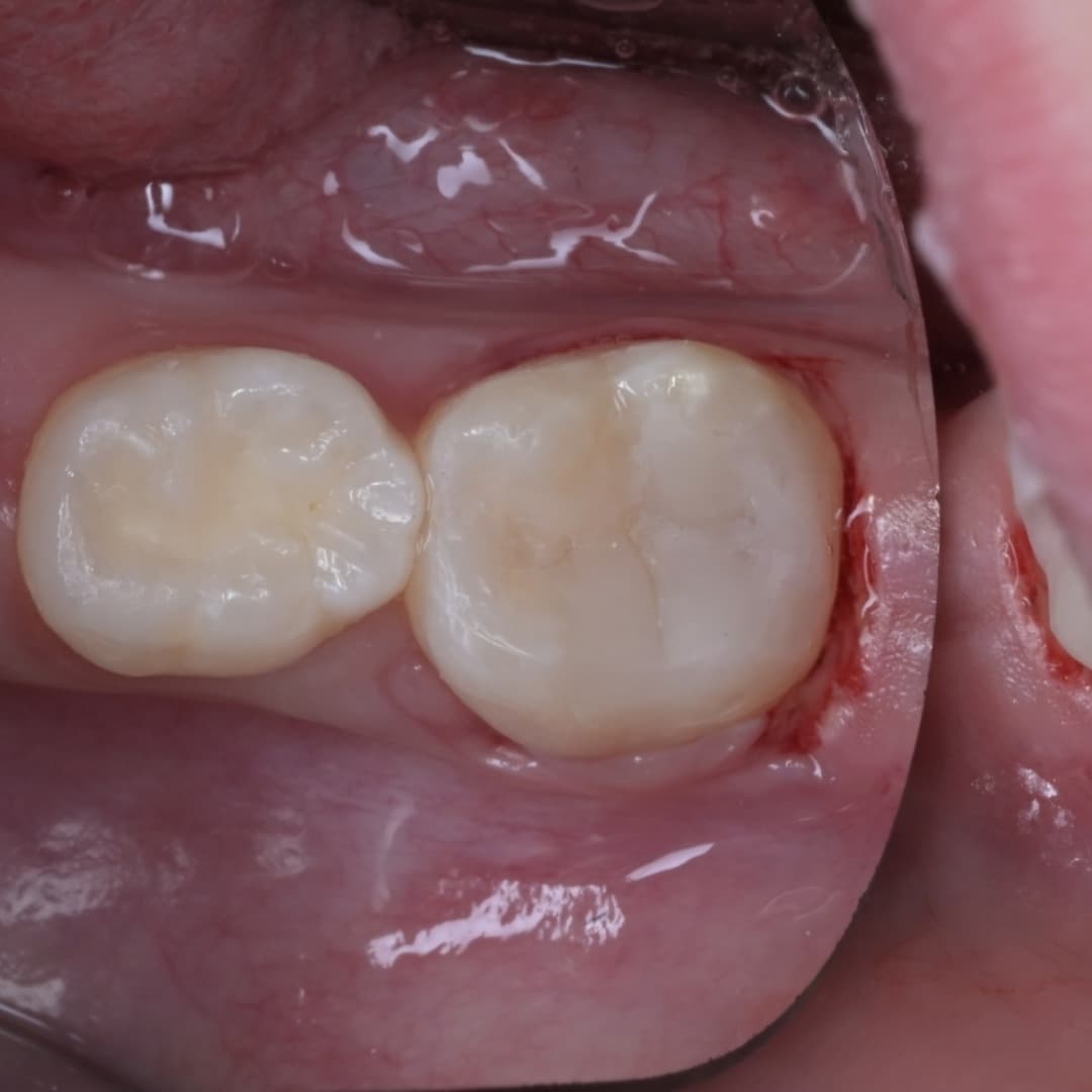 레진빌드업 슬라이드 9/9