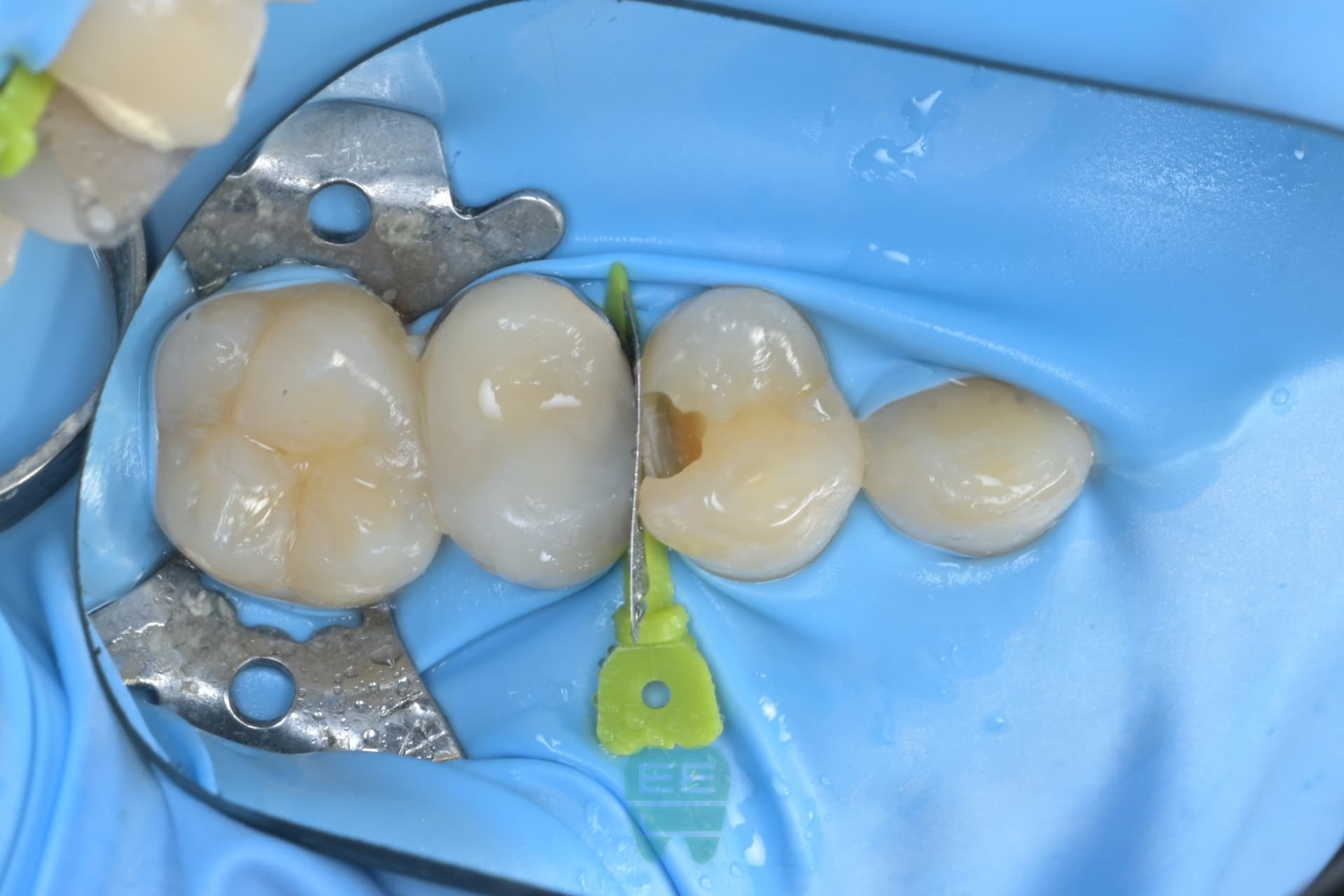 #14 레진빌드업 임상사진 - 신영통튼튼이치과