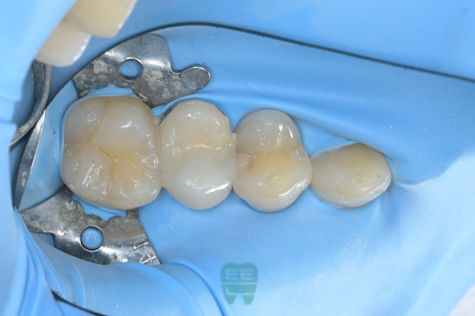 #14 레진빌드업 임상사진 - 신영통튼튼이치과