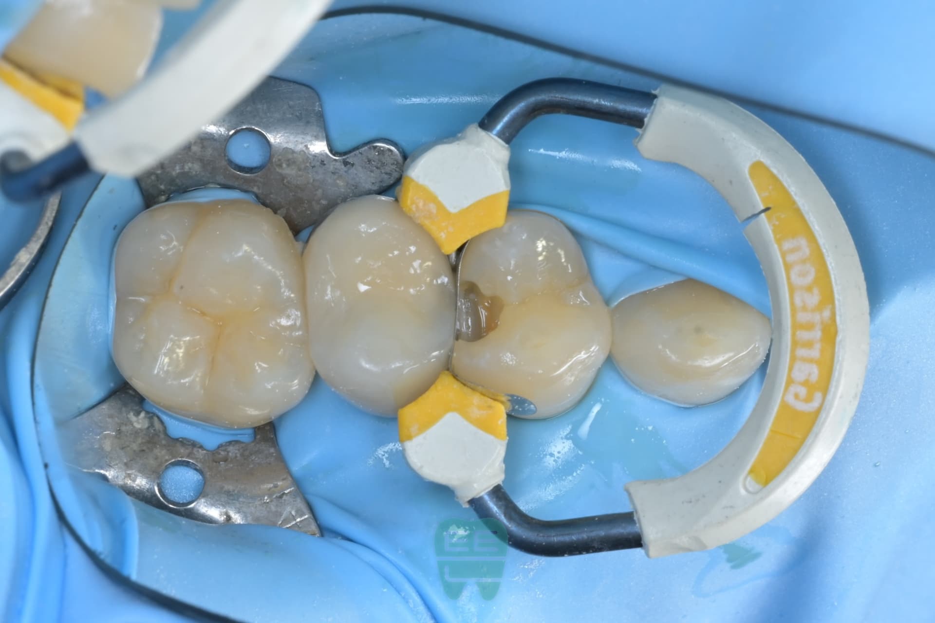 #14 레진빌드업 임상사진 - 신영통튼튼이치과