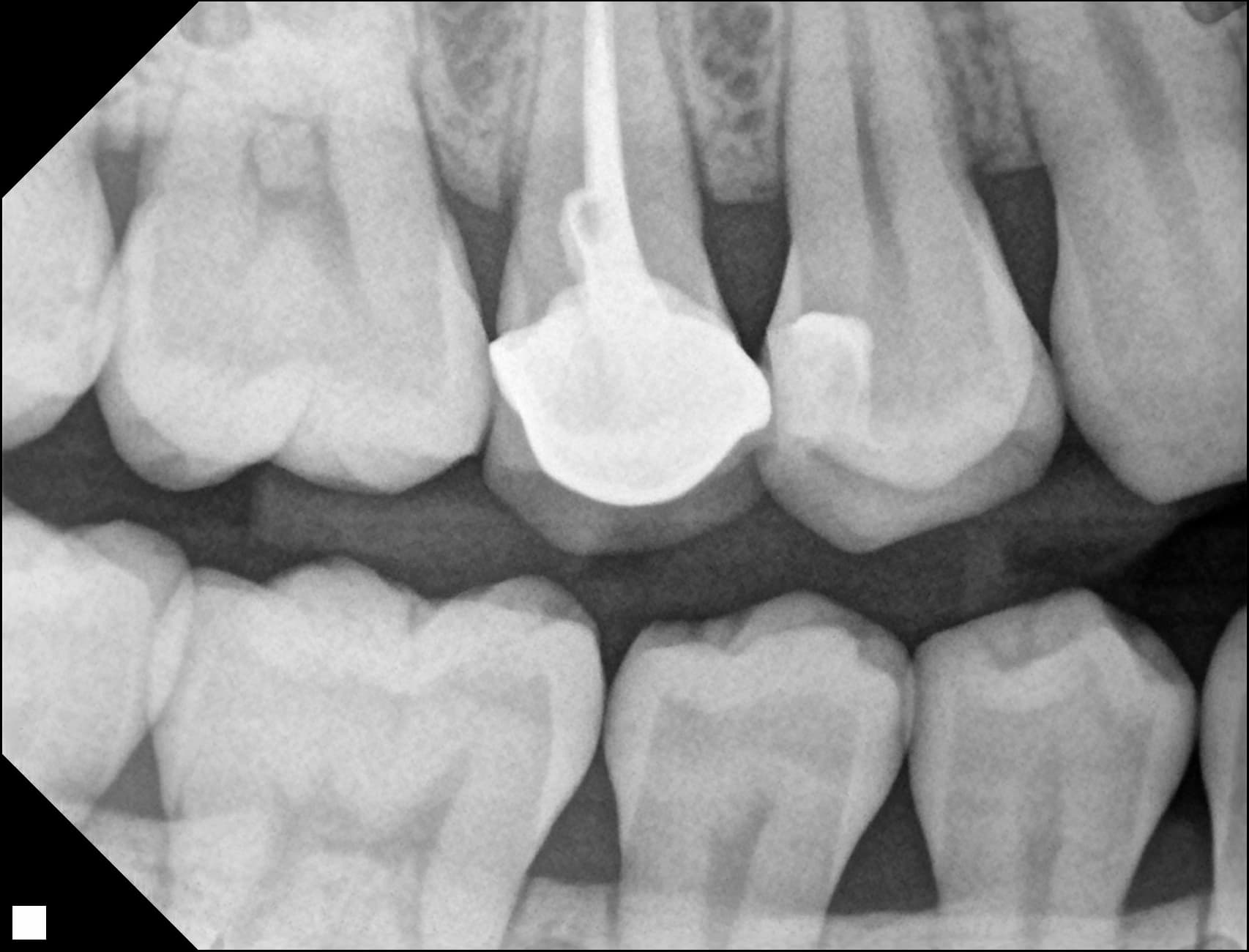 #14 레진빌드업 임상사진 - 신영통튼튼이치과