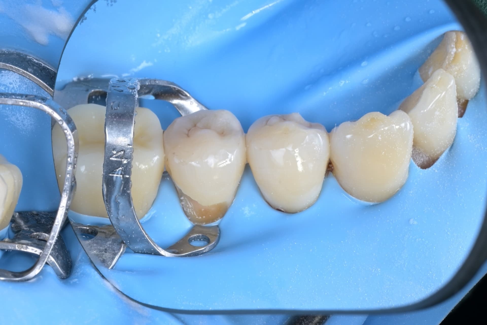 #33, #34, #35 레진빌드업, 치경부레진 임상사진 - 신영통튼튼이치과