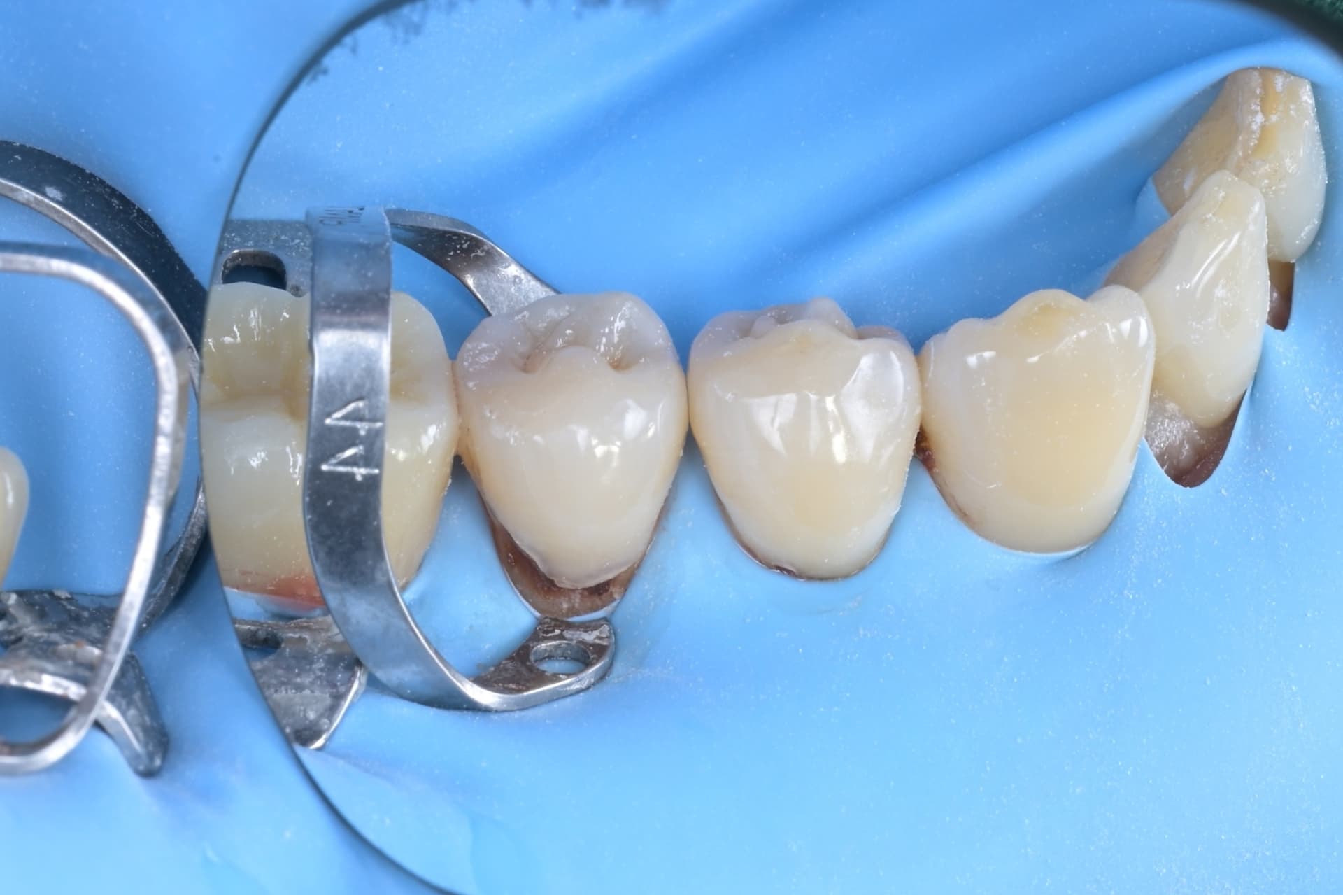 #33, #34, #35 레진빌드업, 치경부레진 임상사진 - 신영통튼튼이치과