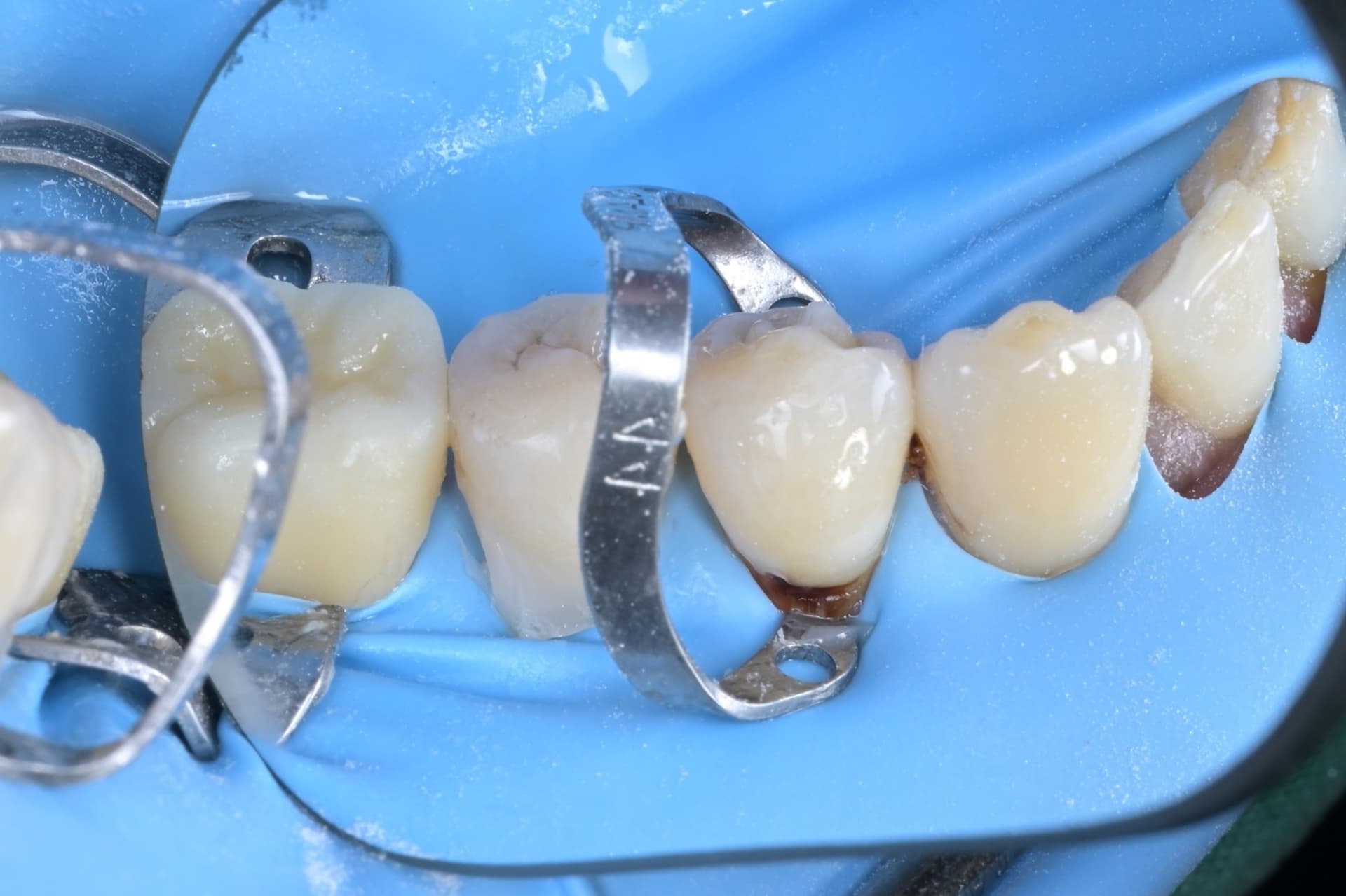 #33, #34, #35 레진빌드업, 치경부레진 임상사진 - 신영통튼튼이치과