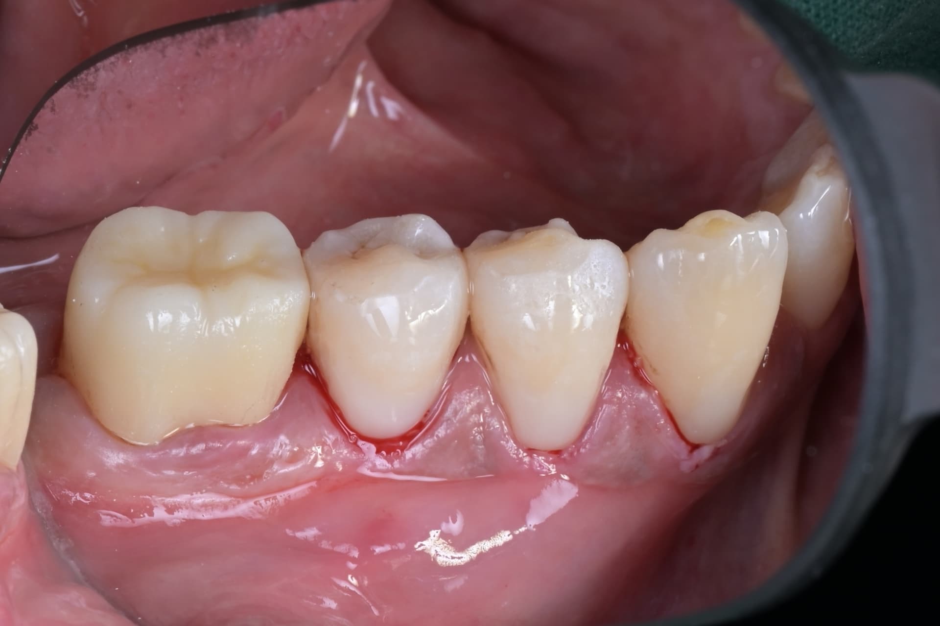 #33, #34, #35 레진빌드업, 치경부레진 임상사진 - 신영통튼튼이치과