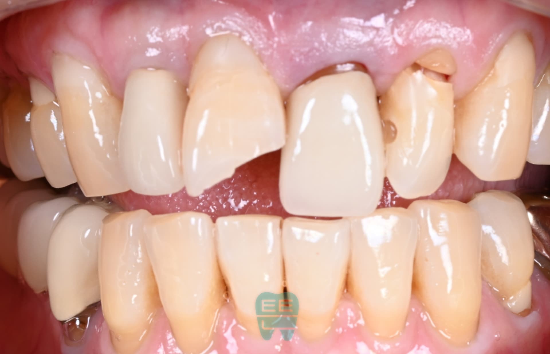 외상치아 레진빌드업 - 신영통튼튼이치과