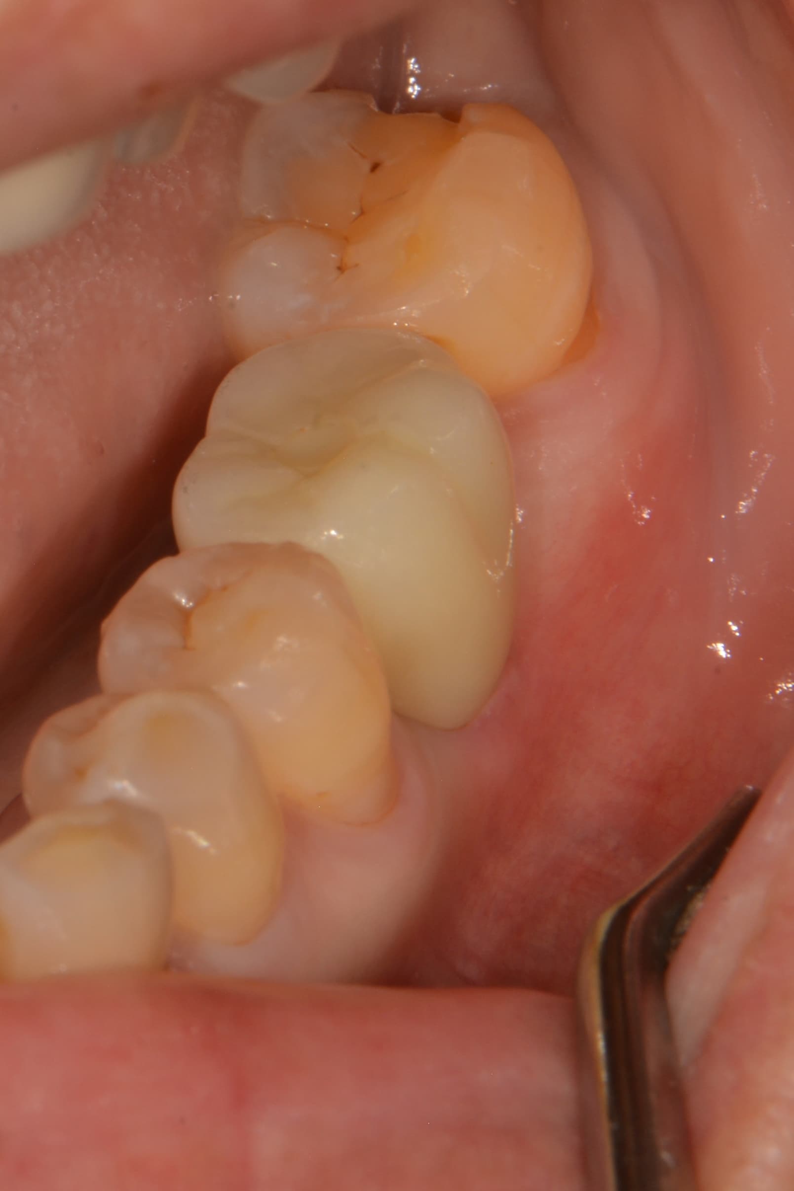 #36 잇몸이식(FGG), 임플란트보철 - 신영통튼튼이치과 - 임플란트 썸네일