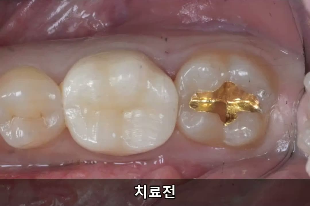 #37 레진빌드업 - 신영통튼튼이치과