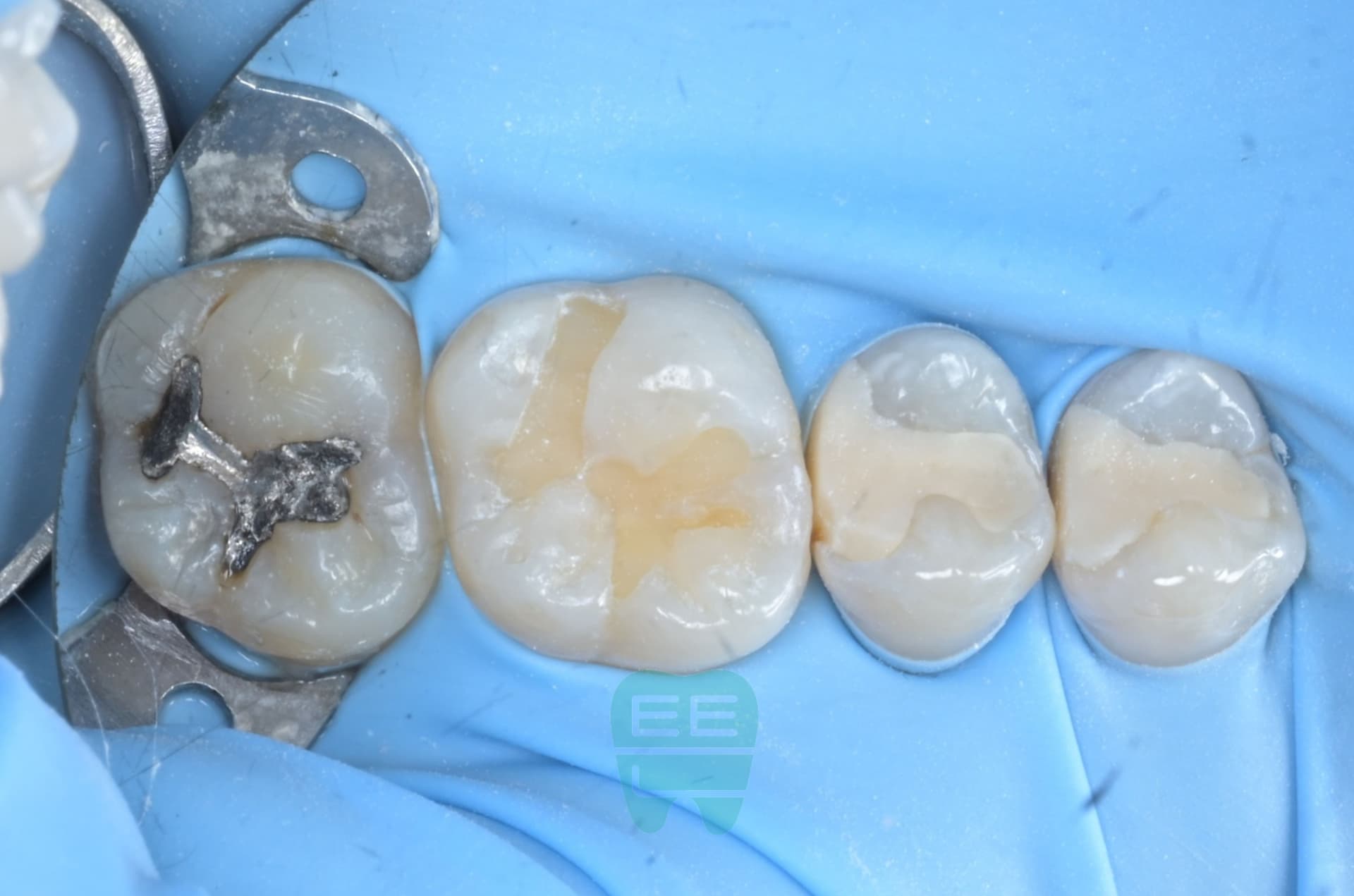 최소침습 레진빌드업을 통한 minimal invasive dentistry 임상사진