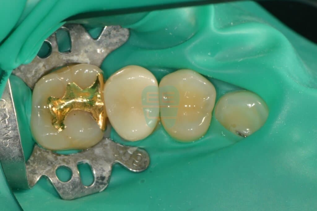 It Looks Fine on the Outside but Is Decaying Inside? Treating Interproximal Caries with Resin Build-up Instead of an Inlay - Resin Build-up thumbnail