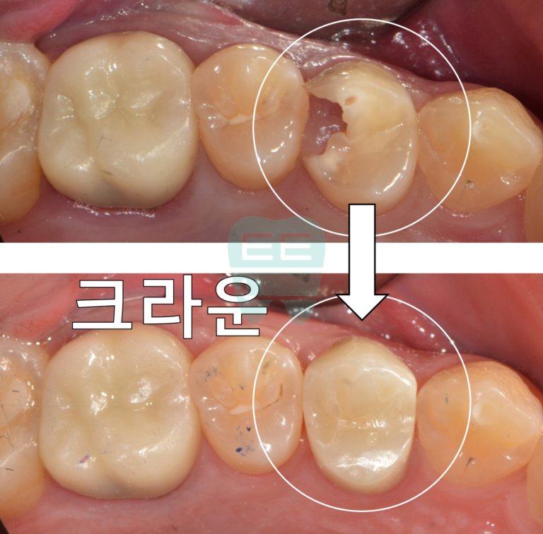발치 선고 받은 치아를 살린 신영통튼튼이치과 치료 증례