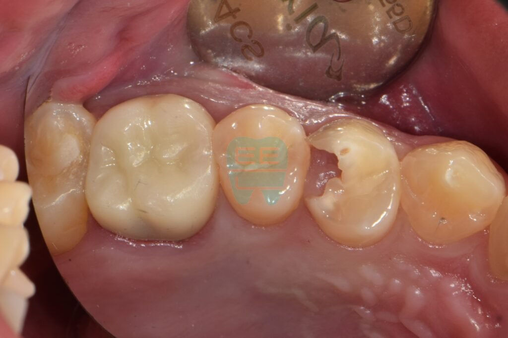 발치 선고 받은 치아 - 잇몸이 치아 내부로 증식된 치료 전 상태