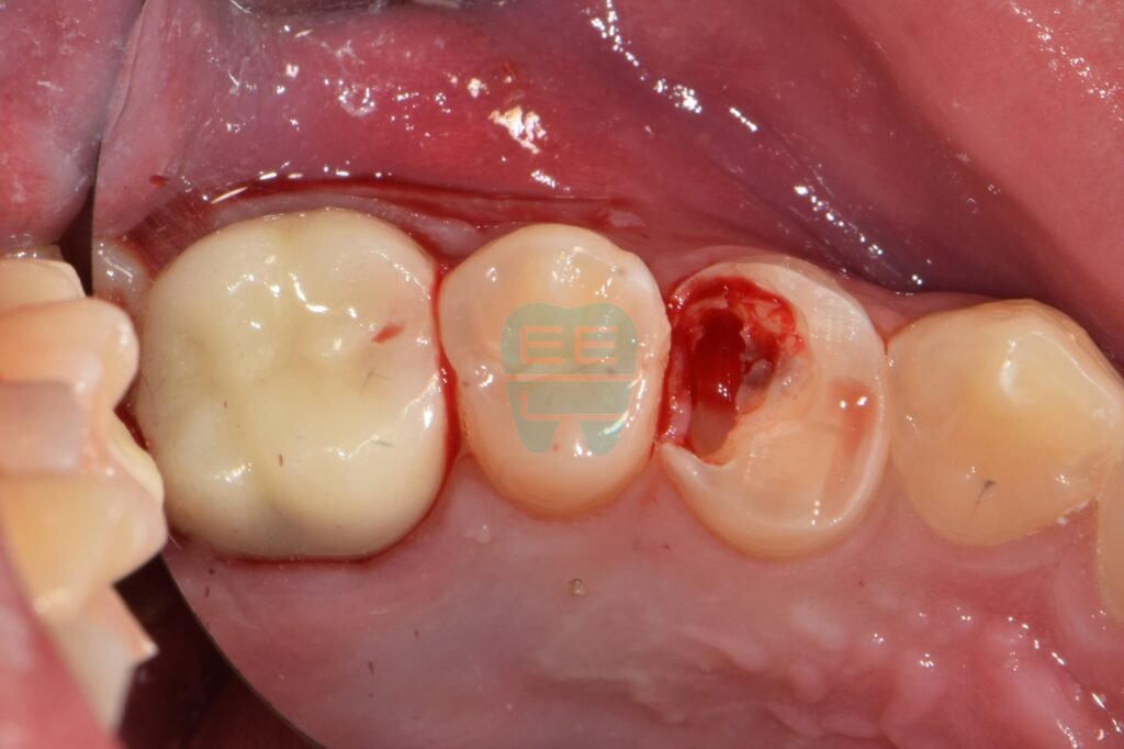 치관확장술로 잇몸 정리 후 치아 경계가 드러난 모습