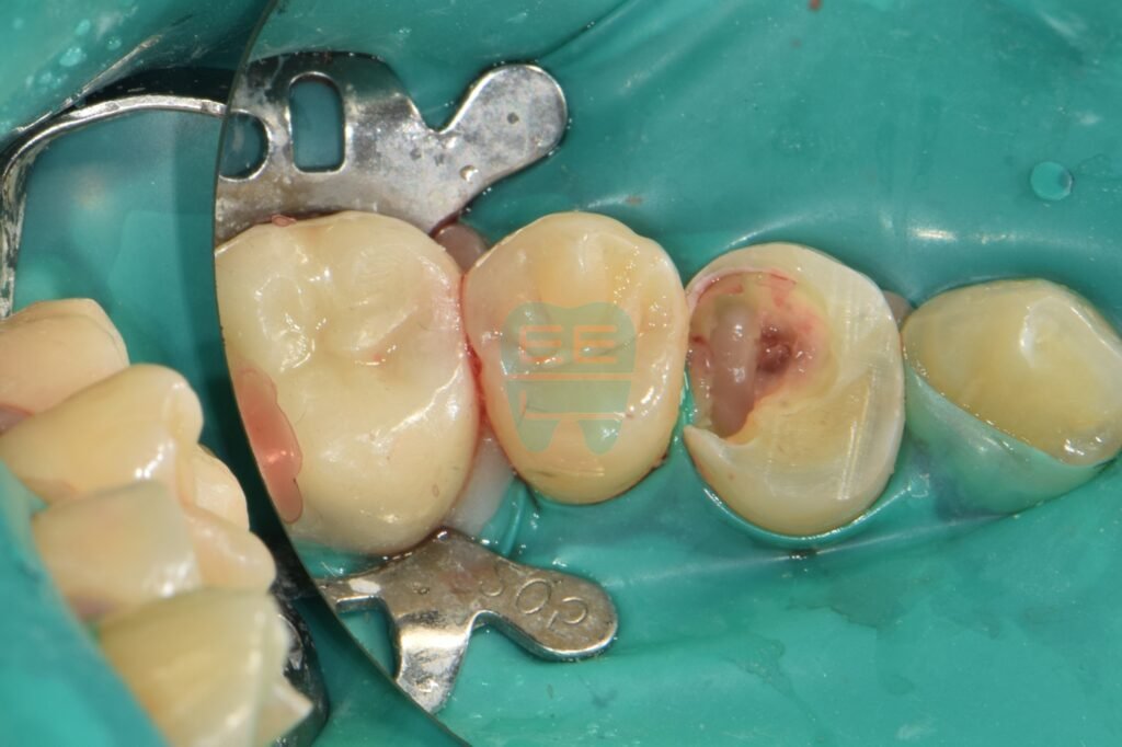 잇몸 수술 후 치아 뿌리와 경계 부위가 노출된 상태