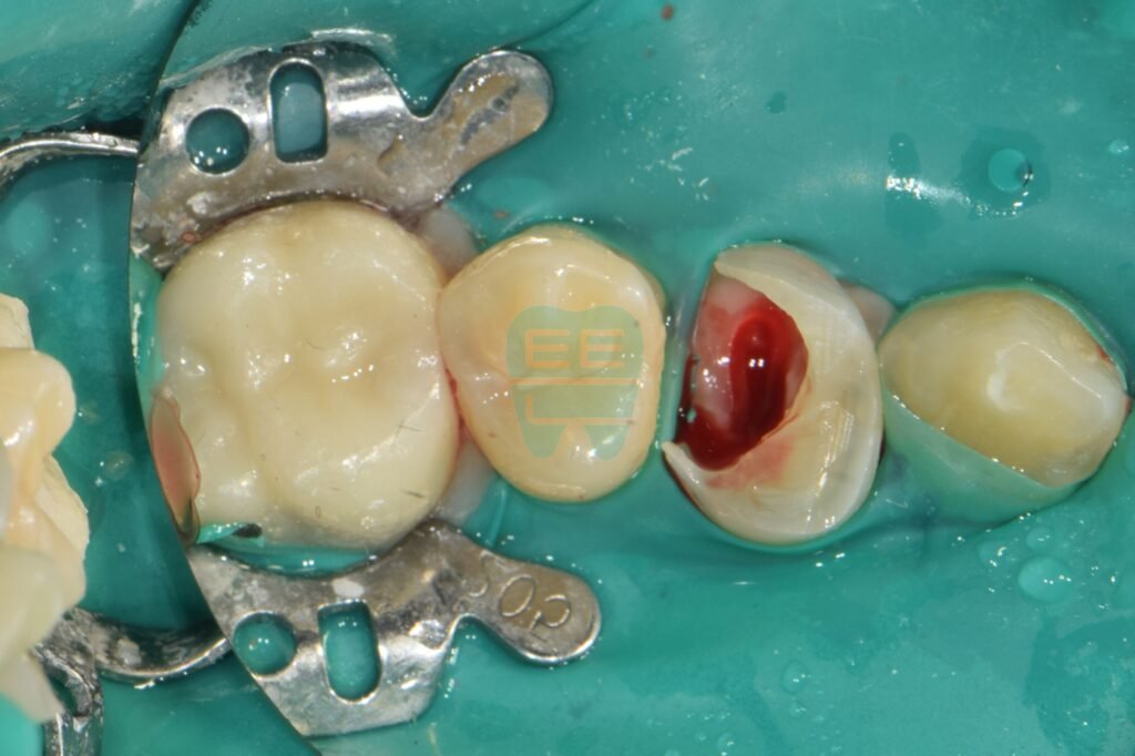 러버댐 장착 후 레진 벽(Wall) 형성 시작