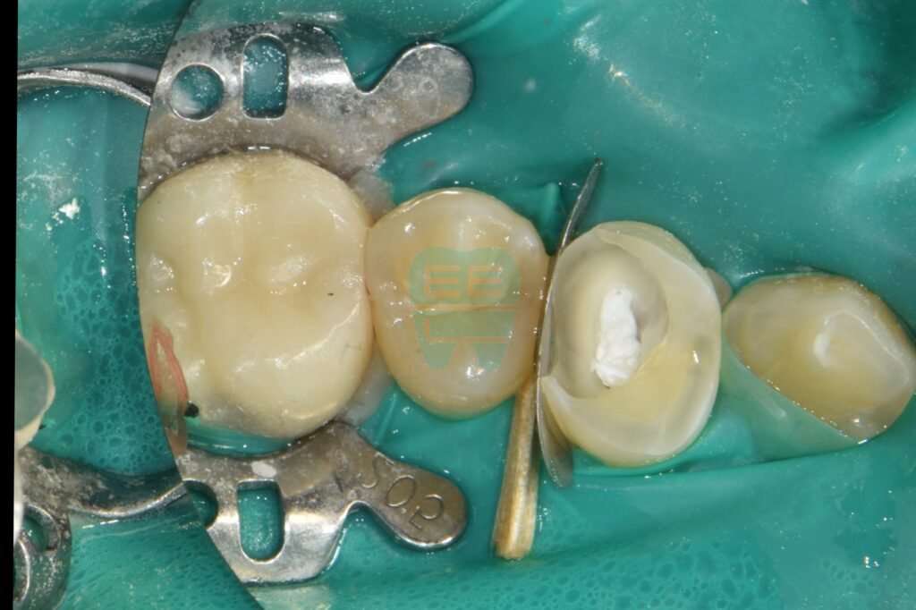 레진으로 무너진 치아 벽을 재건하는 과정