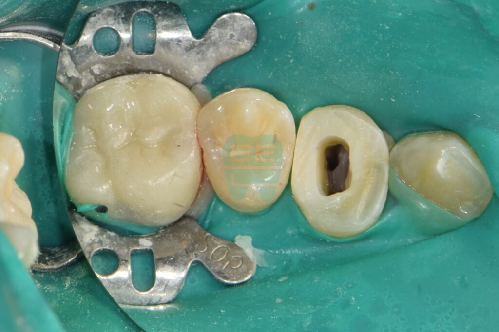 레진 벽(Wall) 형성이 완료되어 신경치료 준비된 모습