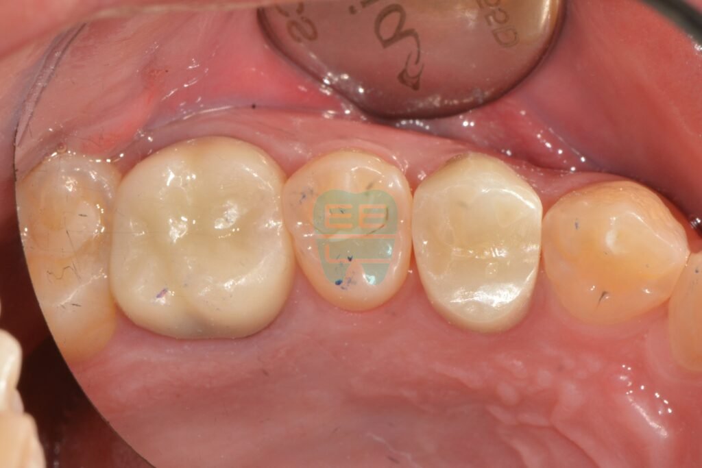 지르코니아 크라운 장착 후 치료 완료된 최종 모습
