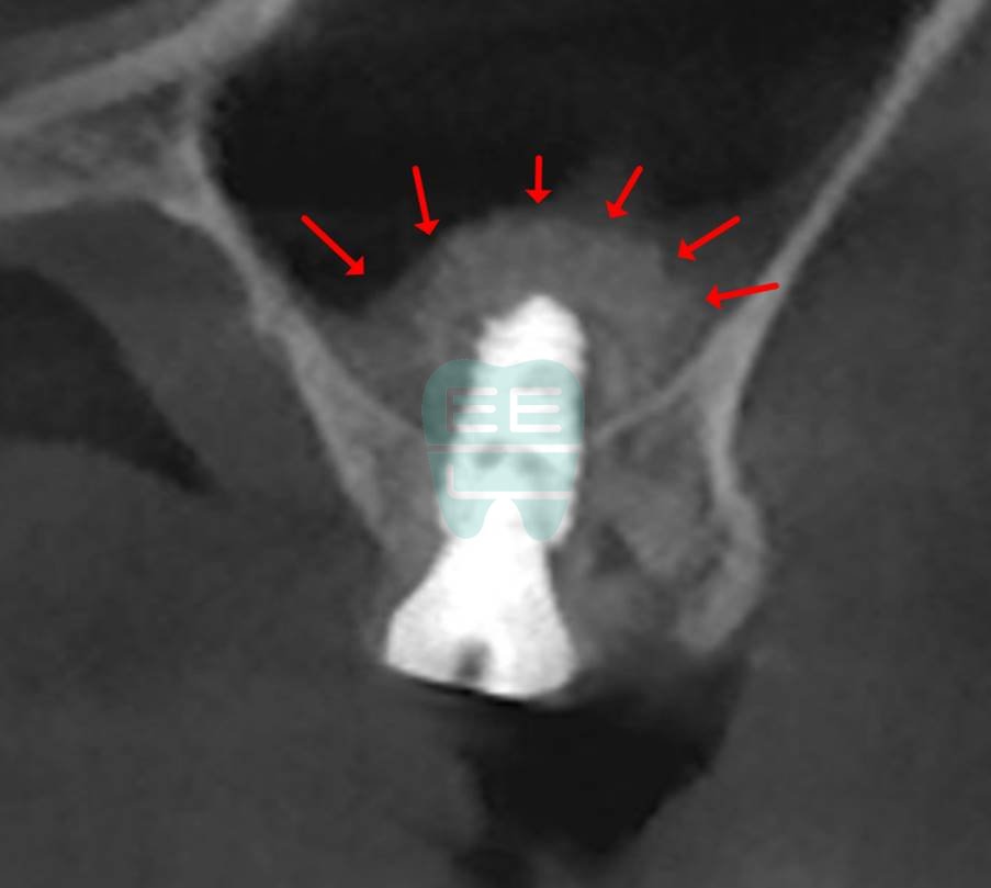 Overview diagram of flapless sinus lift implant surgery