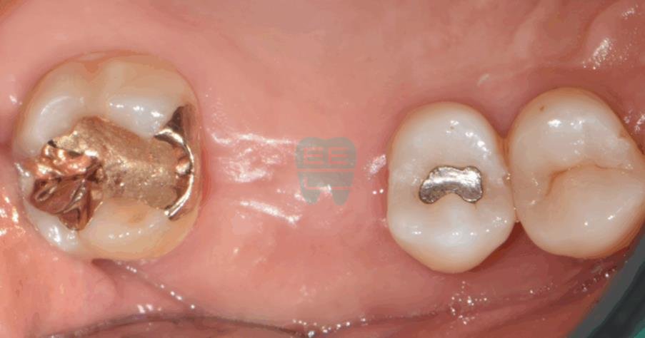 Pre-operative intraoral photo showing the missing tooth site