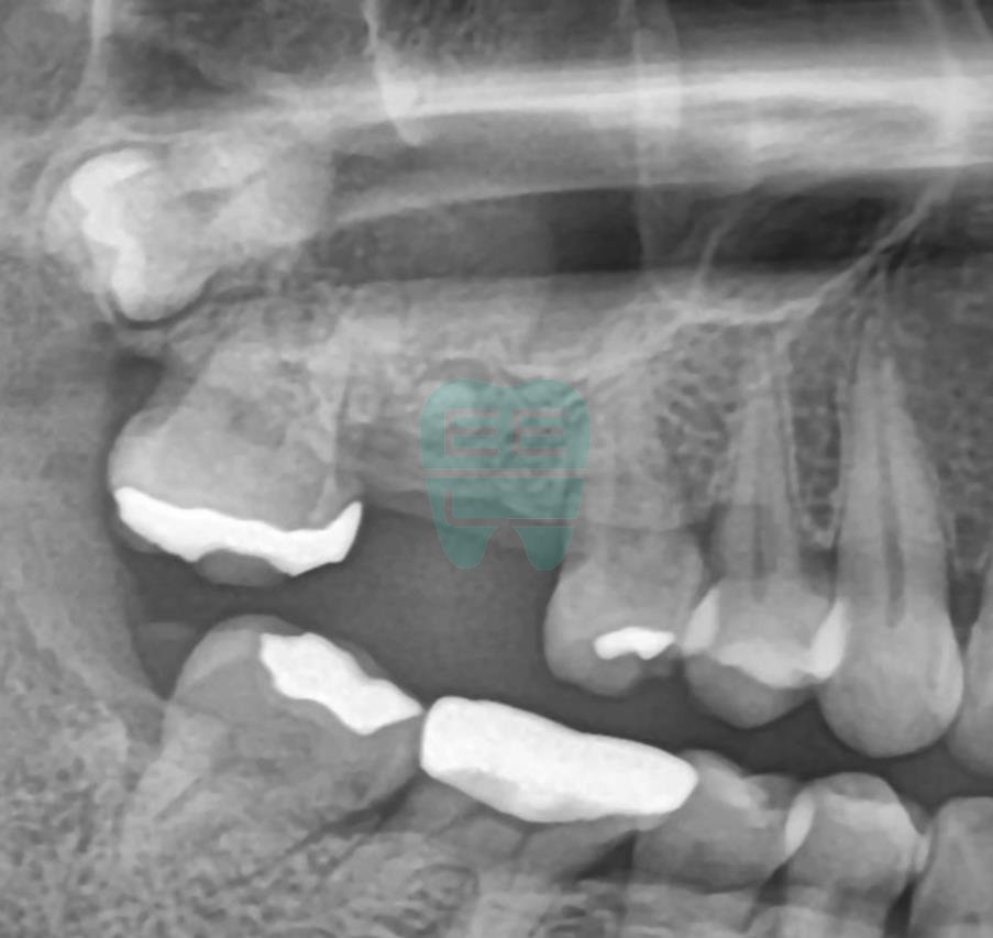 Pre-operative panoramic radiograph showing sinus proximity