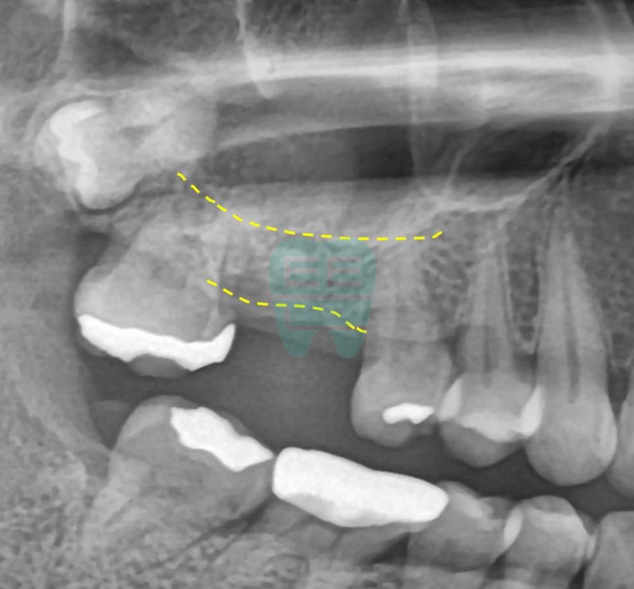 Enlarged panoramic view assessing residual bone height