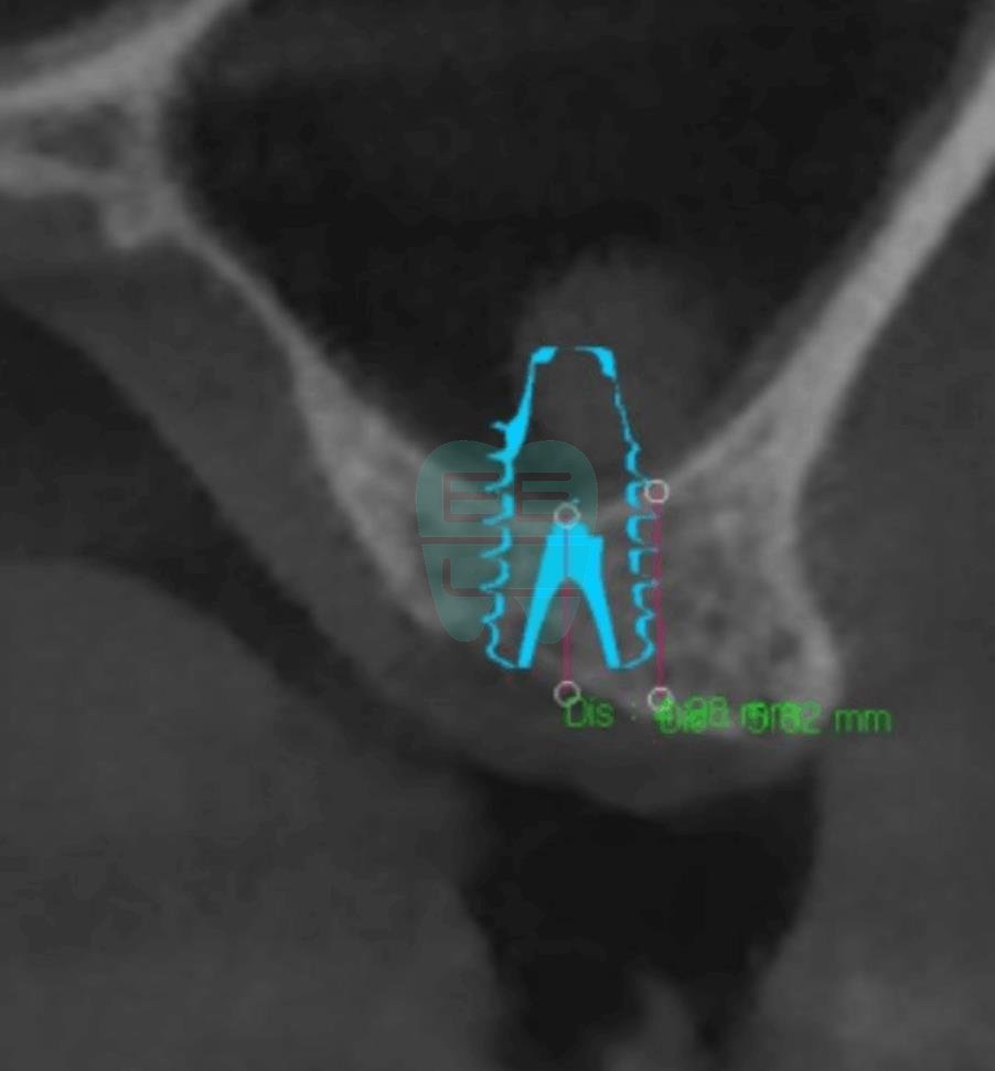 Pre-operative CT scan showing insufficient bone height requiring sinus lift