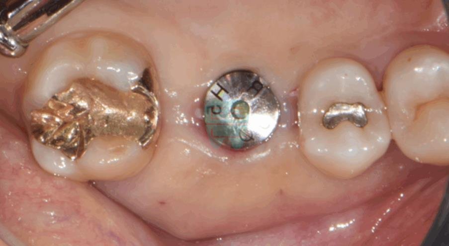 Post-operative intraoral photo — clean site with no incision