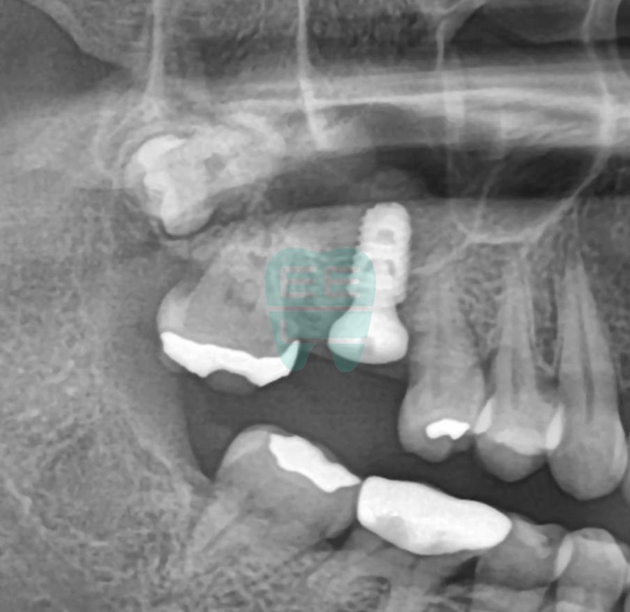 Post-operative panoramic radiograph confirming stable implant placement