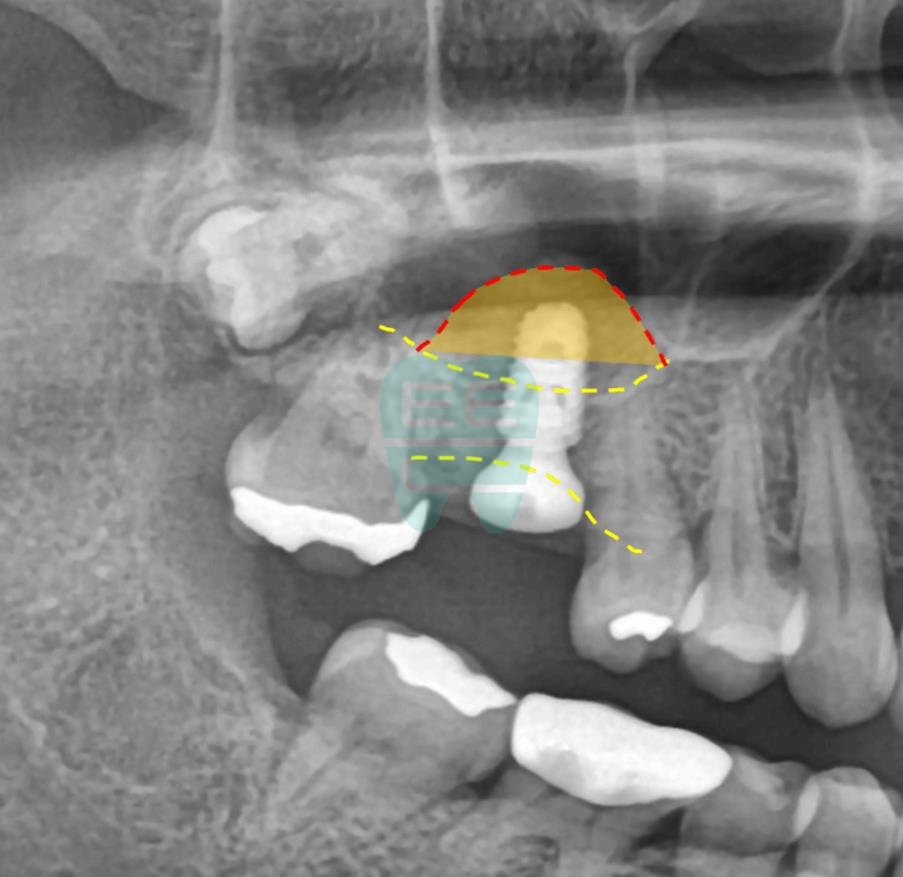 Enlarged post-operative panoramic view confirming sinus elevation