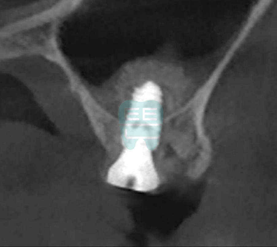 Post-operative CT showing safely elevated sinus membrane — view 1
