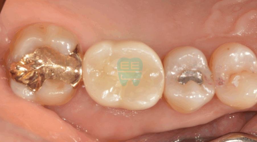 Final prosthesis in place — function and aesthetics restored