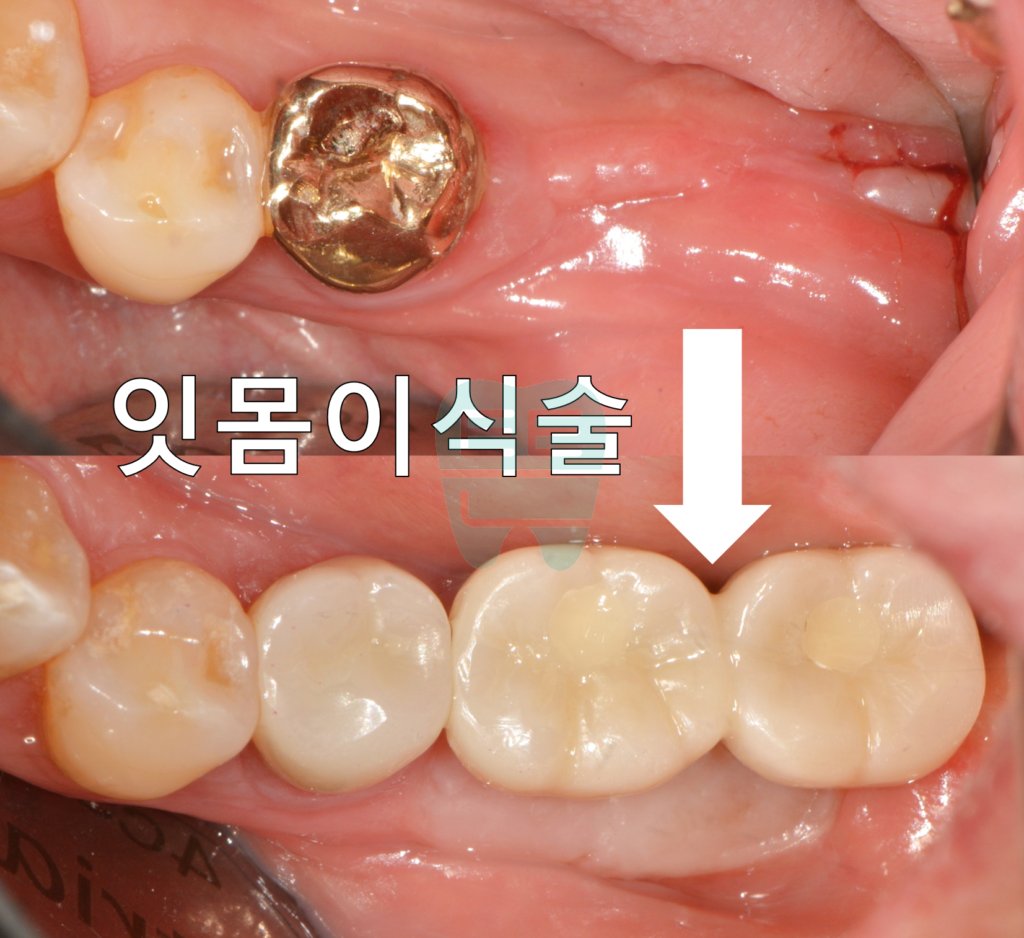 FGG (Free Gingival Graft) and vestibuloplasty implant case overview