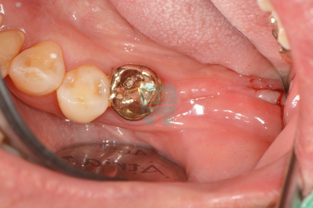 Before treatment — bone atrophy and insufficient attached gingiva at the missing tooth site