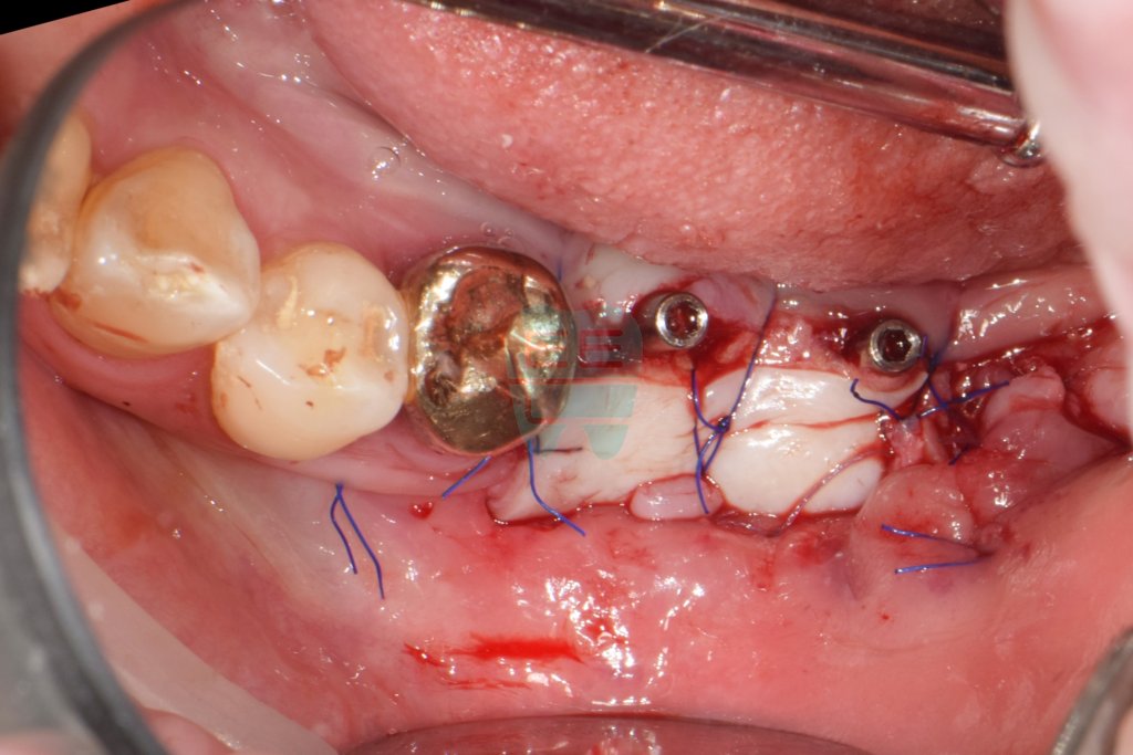 FGG and vestibuloplasty performed during implant second-stage surgery