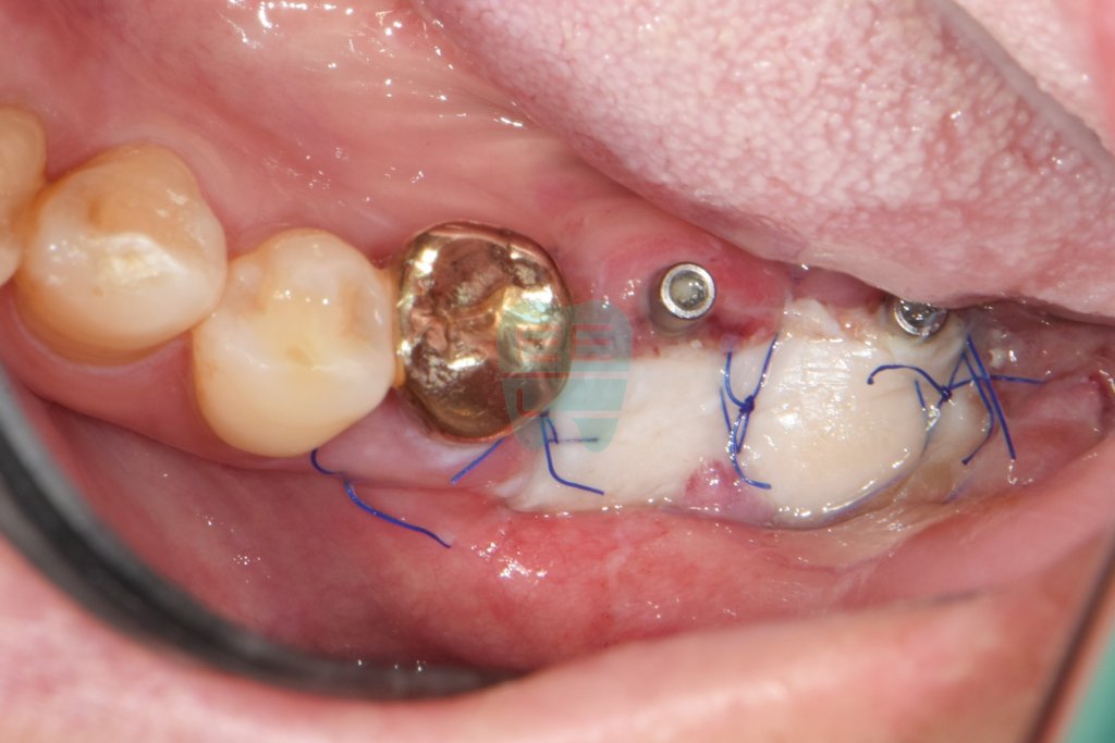 Day after gum graft — early graft integration