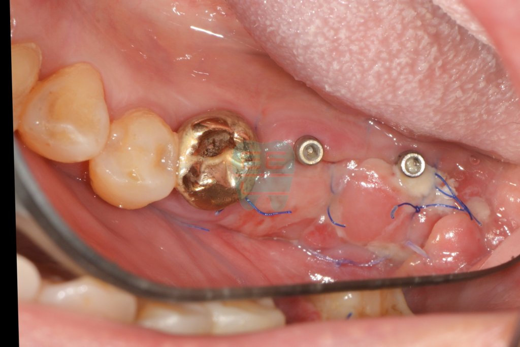 One week after gum graft — stable healing progress