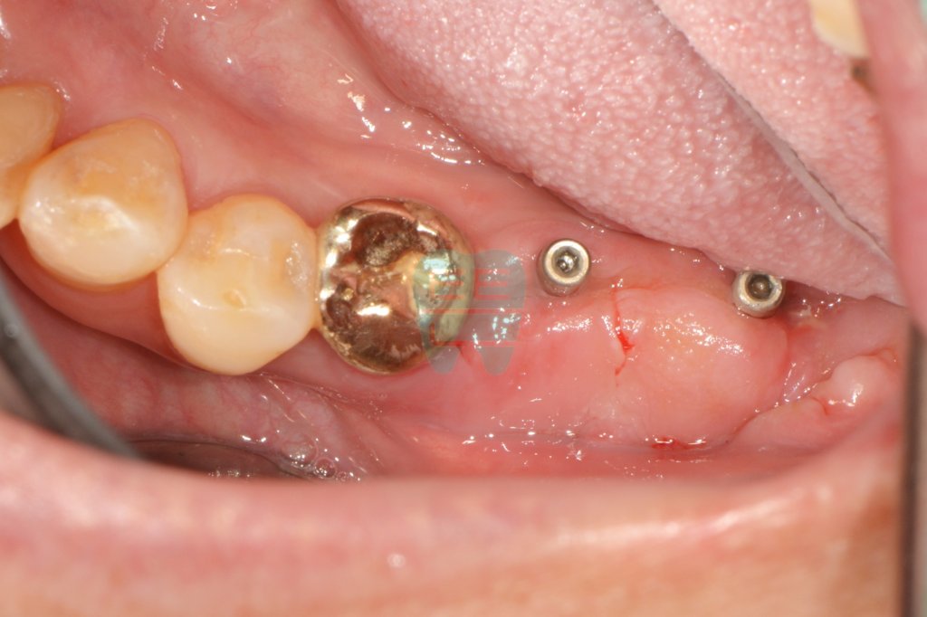 Two weeks after gum graft — graft fully integrated
