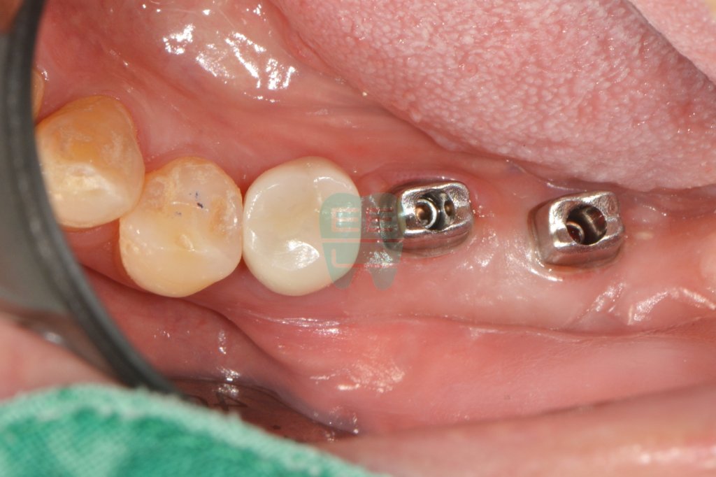 Custom abutment connected — grafted gum tissue protecting the implant