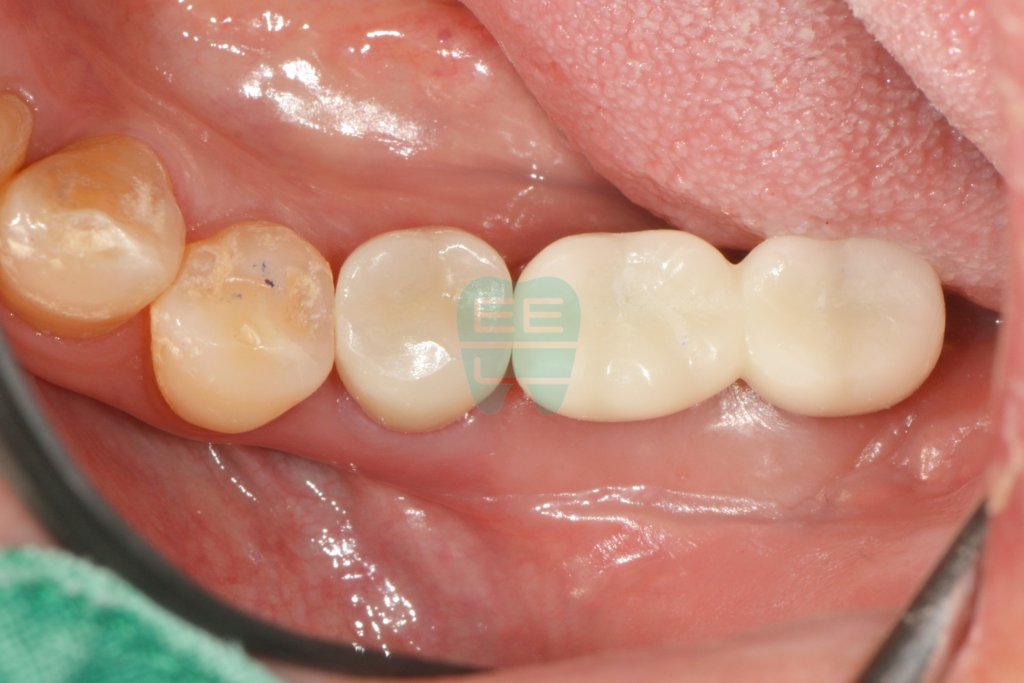 Provisional crown in place