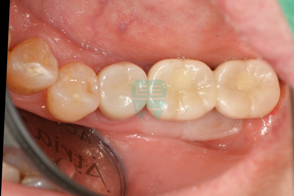 Final zirconia prosthesis in place
