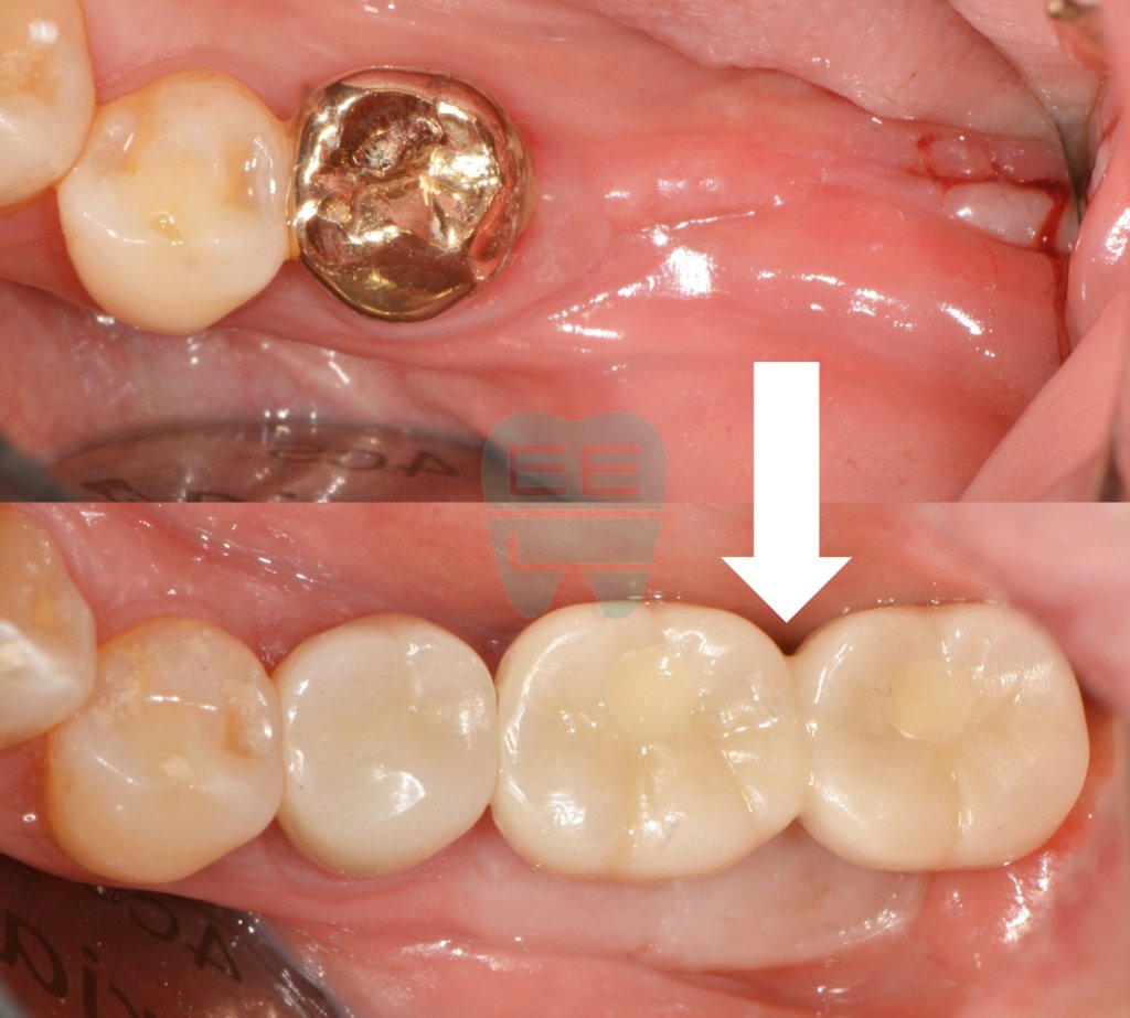 Before and after comparison — firm attached gingiva created through FGG